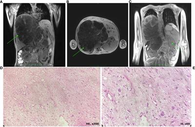 Case report: First case of undifferentiated embryonal sarcoma of the liver in a child with neurofibromatosis type 1, treated by hepatic chemoperfusion with transcatheter arterial chemoembolization